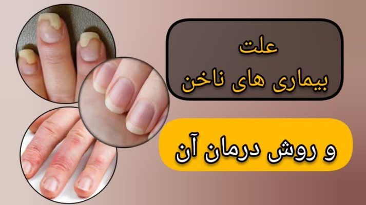 علت بیماری های ناخن و روش درمان آن