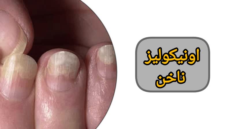 اونیکولیز ناخن