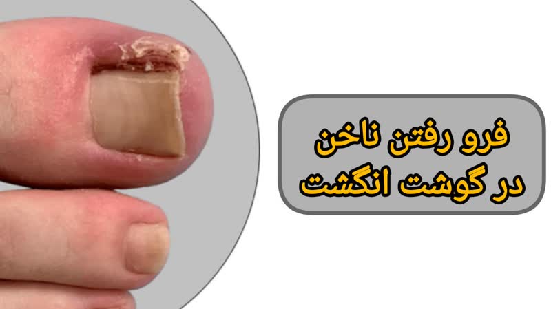 فرورفتن ناخن در گوشت انگشت