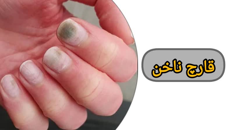 قارچ ناخن