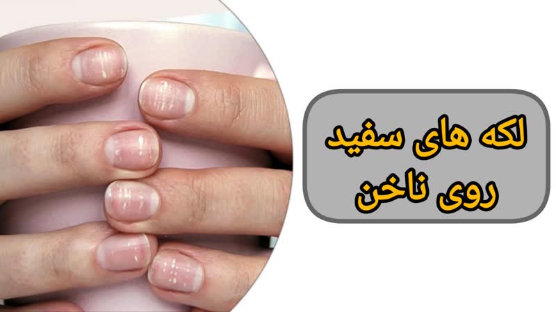 لکه های سفید روی ناخن