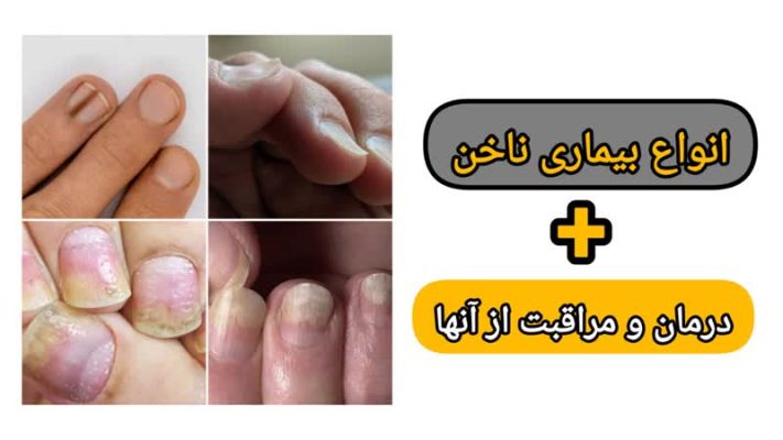 انواع بیماری ناخن و نکات مراقبت و درمان آنها