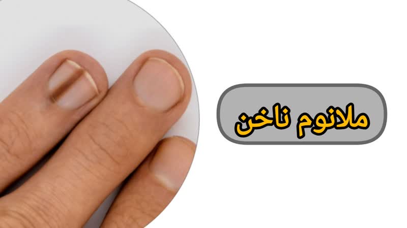 ملانوم ناخن
