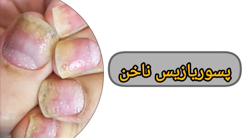 پسوریازیس ناخن